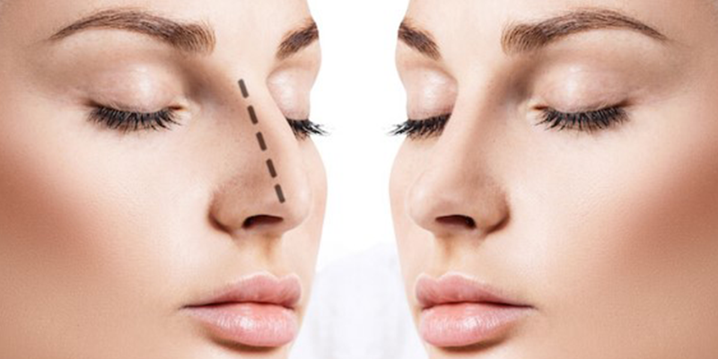 Nose Aesthetics (Rhinoplasty)