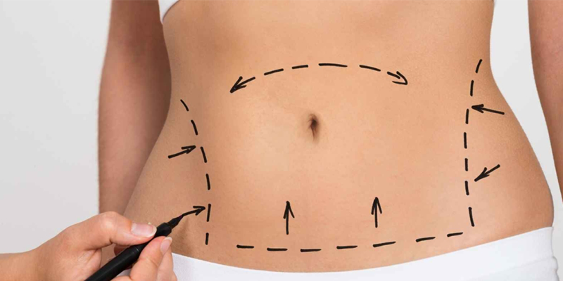 Tummy Tuck (Abdominoplasty)